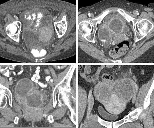 Tubo-Ovarian Abscess CT Findings