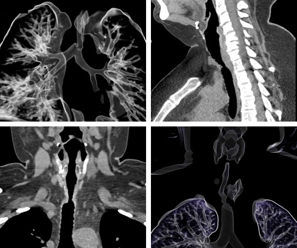 Tracheal Stenosis