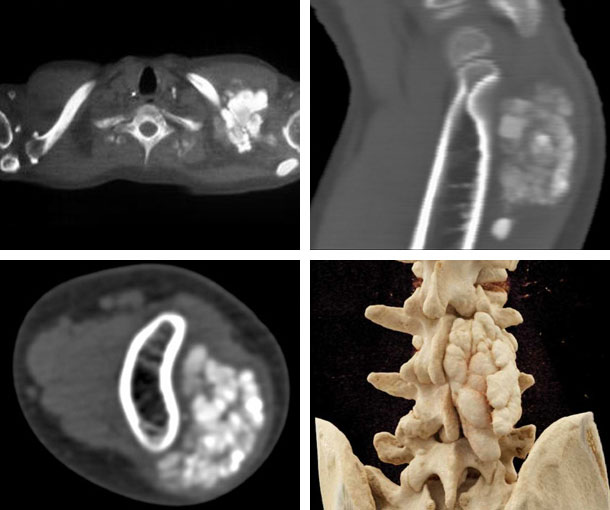 Tumoral Calcinosis CT Findings