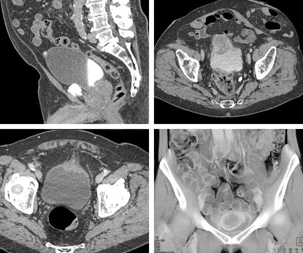 Urachal Carcinoma CT Findings