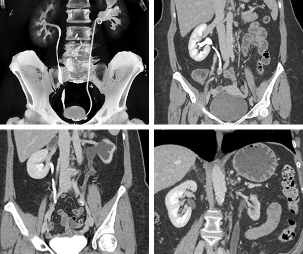 Ureteral TCC CT Findings