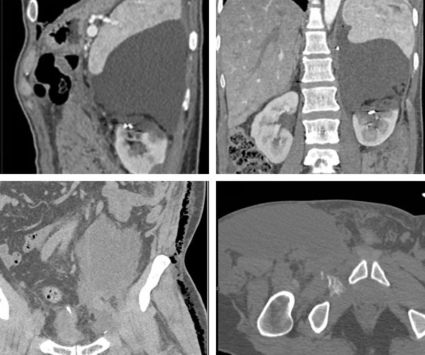 Urinoma CT Findings