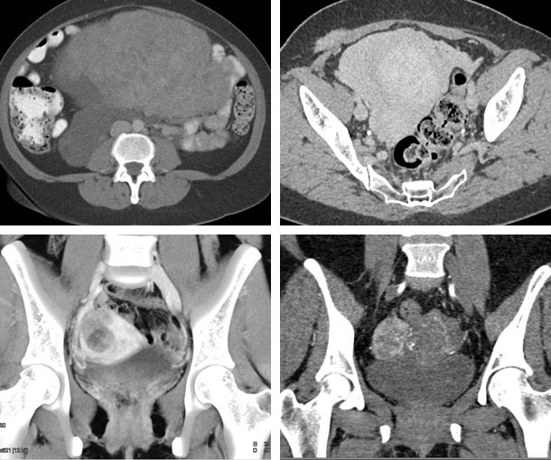 Uterine Fibroids CT Findings