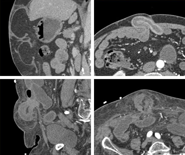 Ventral Hernia CT Findings