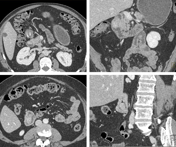 Villous Adenoma CT Findings