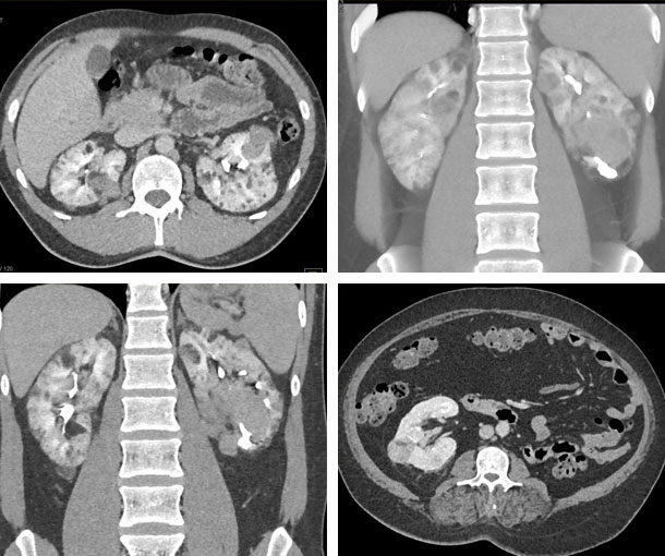 Von Hippel-Lindau CT Findings