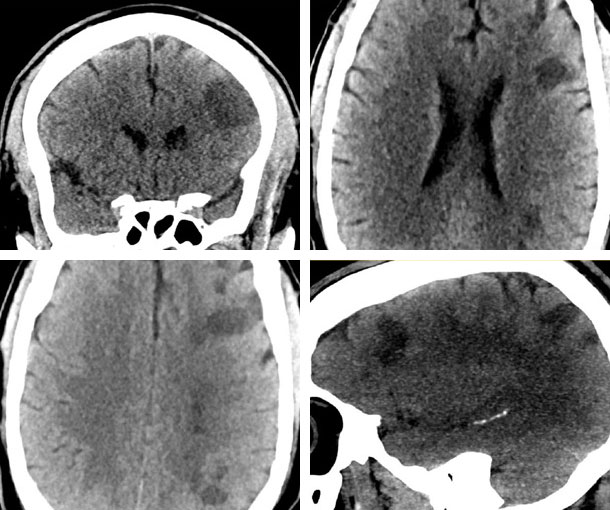 Watershed Infarct CT Findings