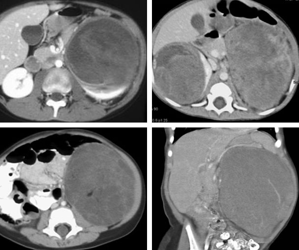 Wilms Tumor CT Appearance