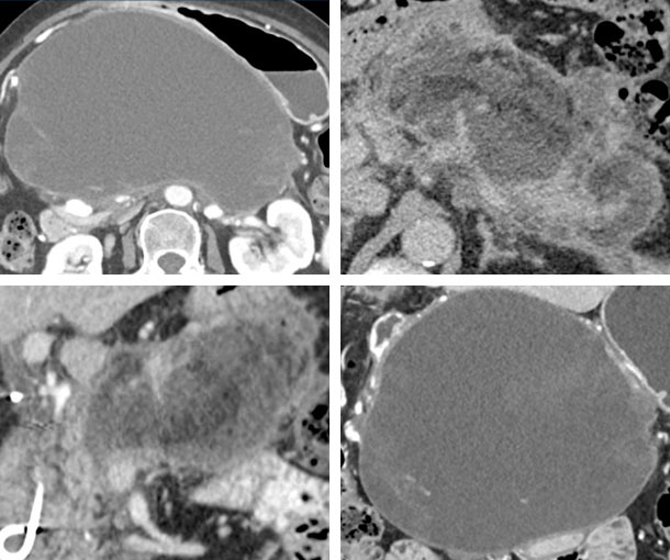 Walled-Off Necrosis CT Findings