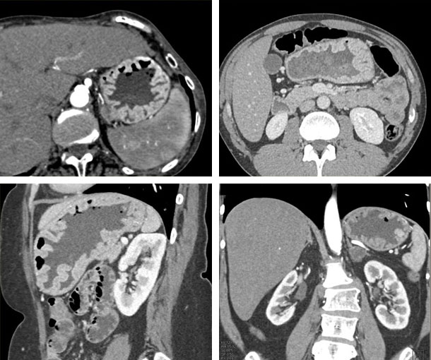 Zollinger-Ellison Syndrome CT Findings
