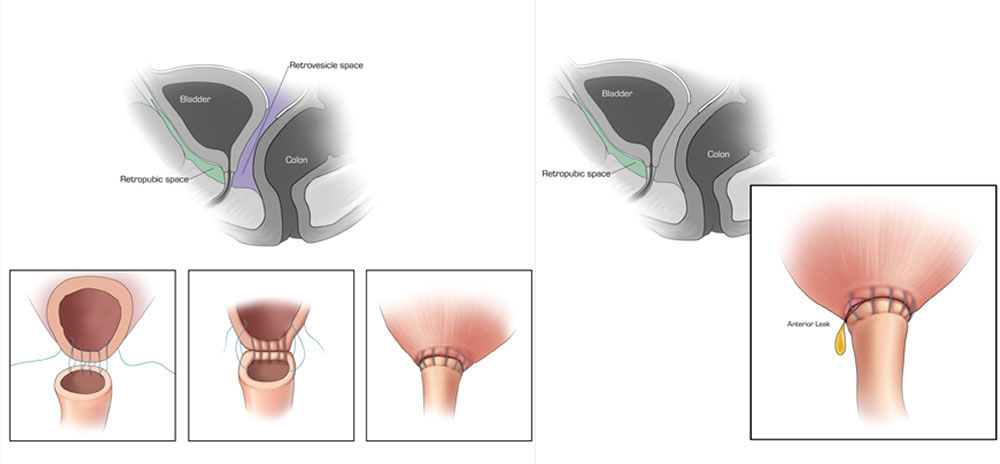 Extraperitoneal anastomotic leak