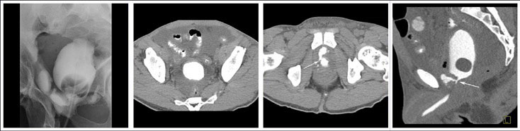 Extraperitoneal anastomotic leak