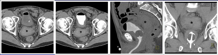 Extraperitoneal anastomotic leak