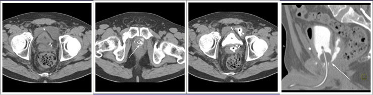 Extraperitoneal anastomotic leak