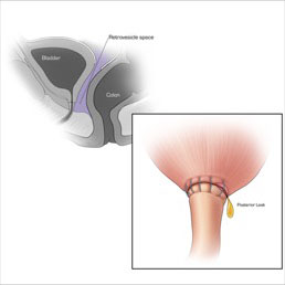 Intraperitoneal anastomotic leak 