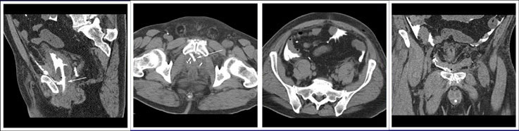 Intraperitoneal anastomotic leak 