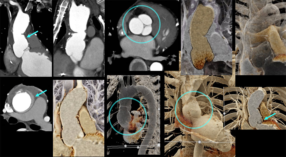 CT of Dilated Root & Prior Repair