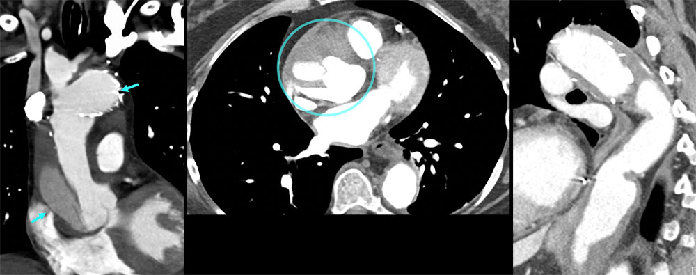 CT of Post Aneurysm Repair, New Dissection