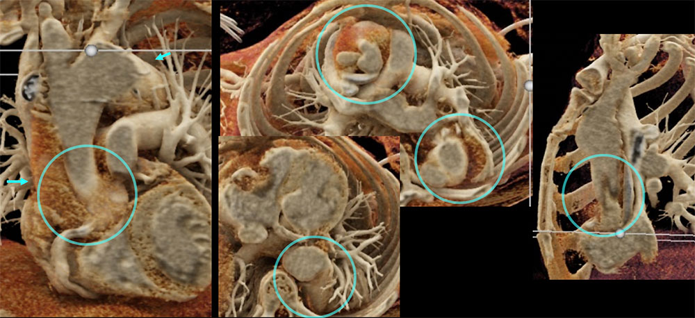 CT of Post Aneurysm Repair, New Dissection