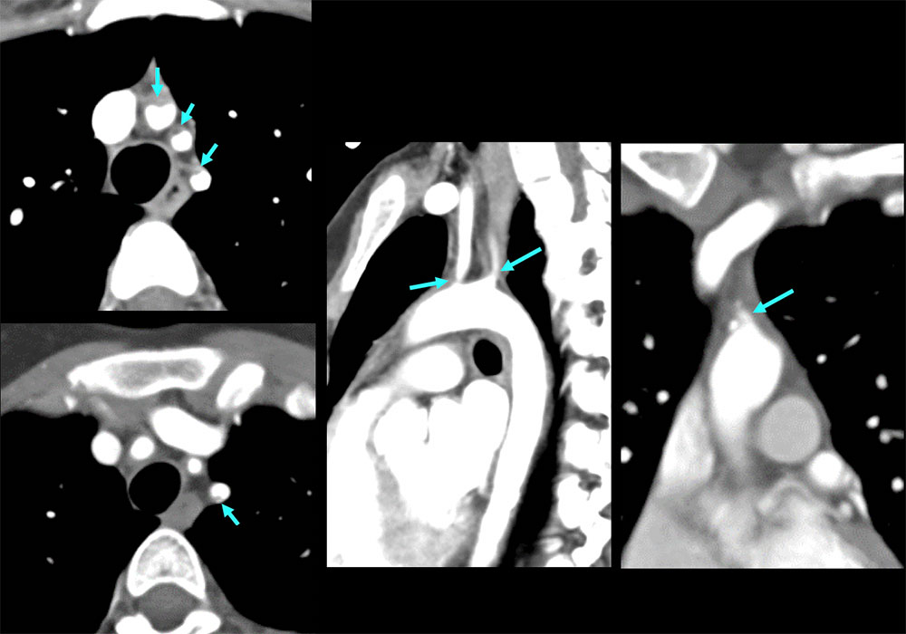 CT of Takayasu Arteritis