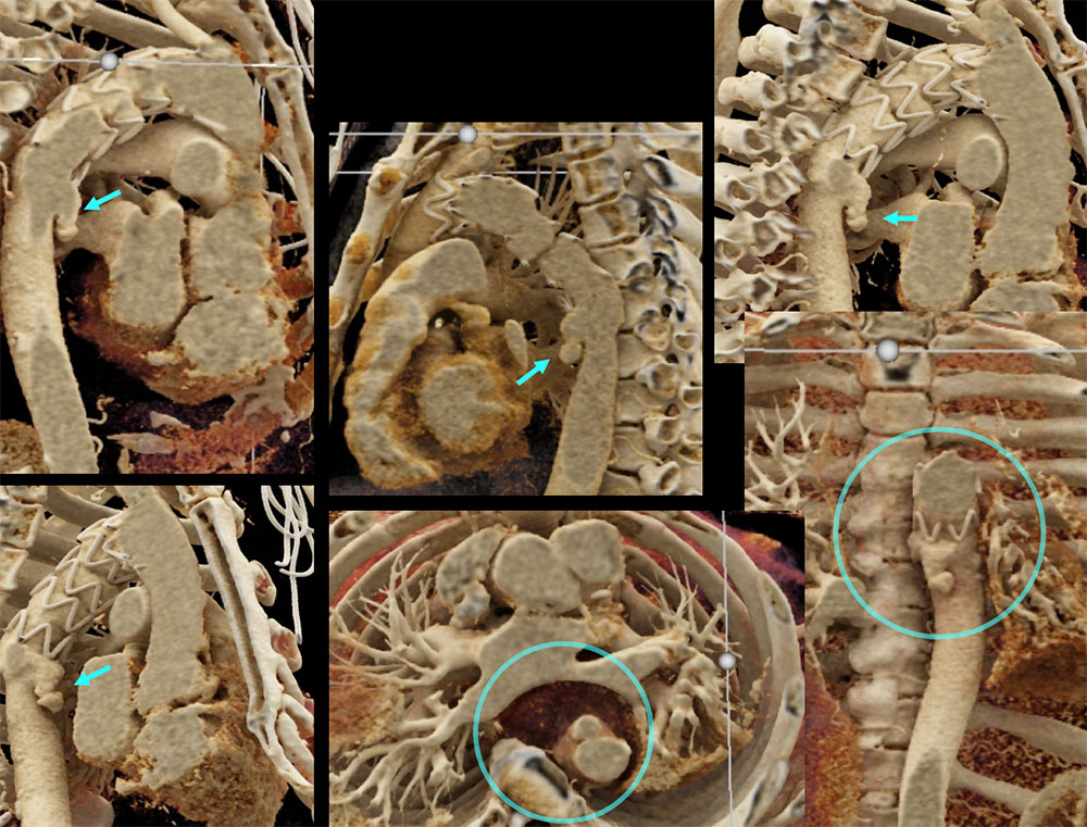 CT of Impending Mycotic Aneurysm Rupture