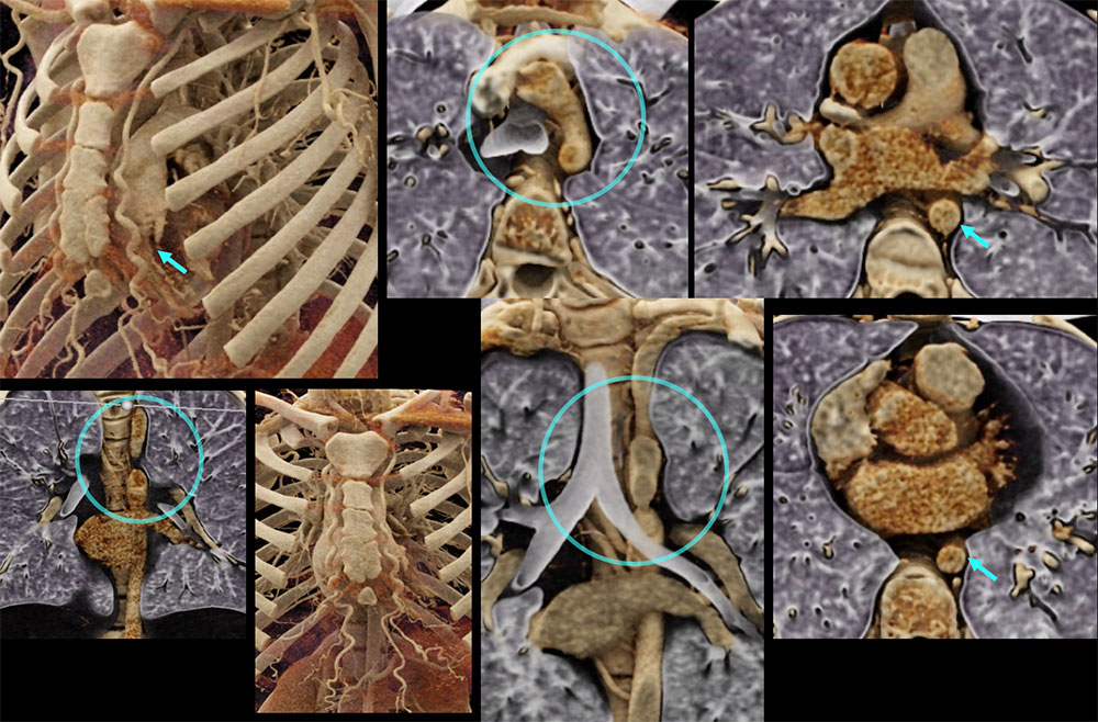 CT of Coarctation (Initial)