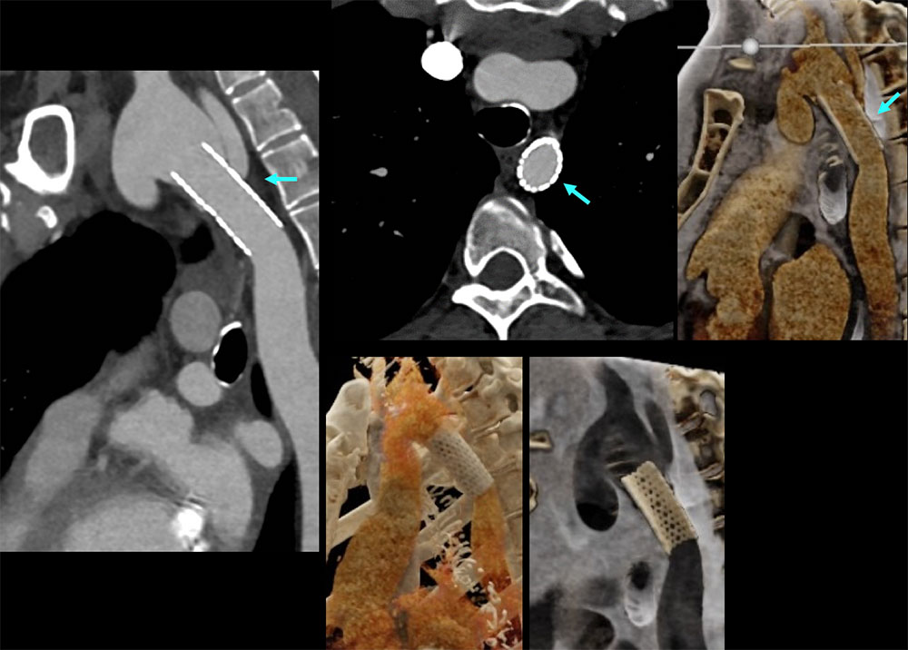 CT of Coarctation, Post-Repair