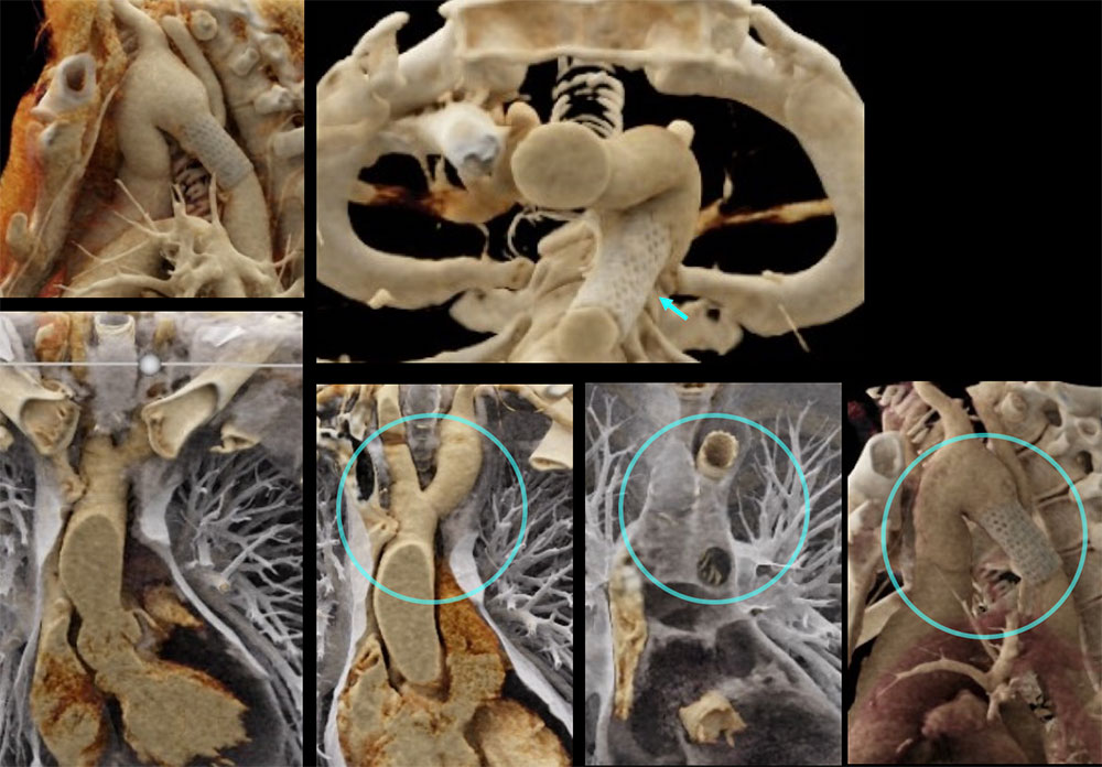 CT of Coarctation, Post-Repair