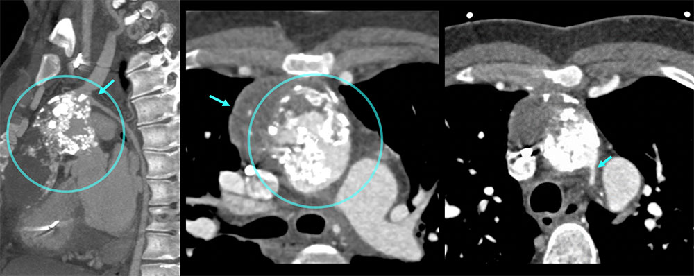 CT of Hypoplastic Arch and Calcification