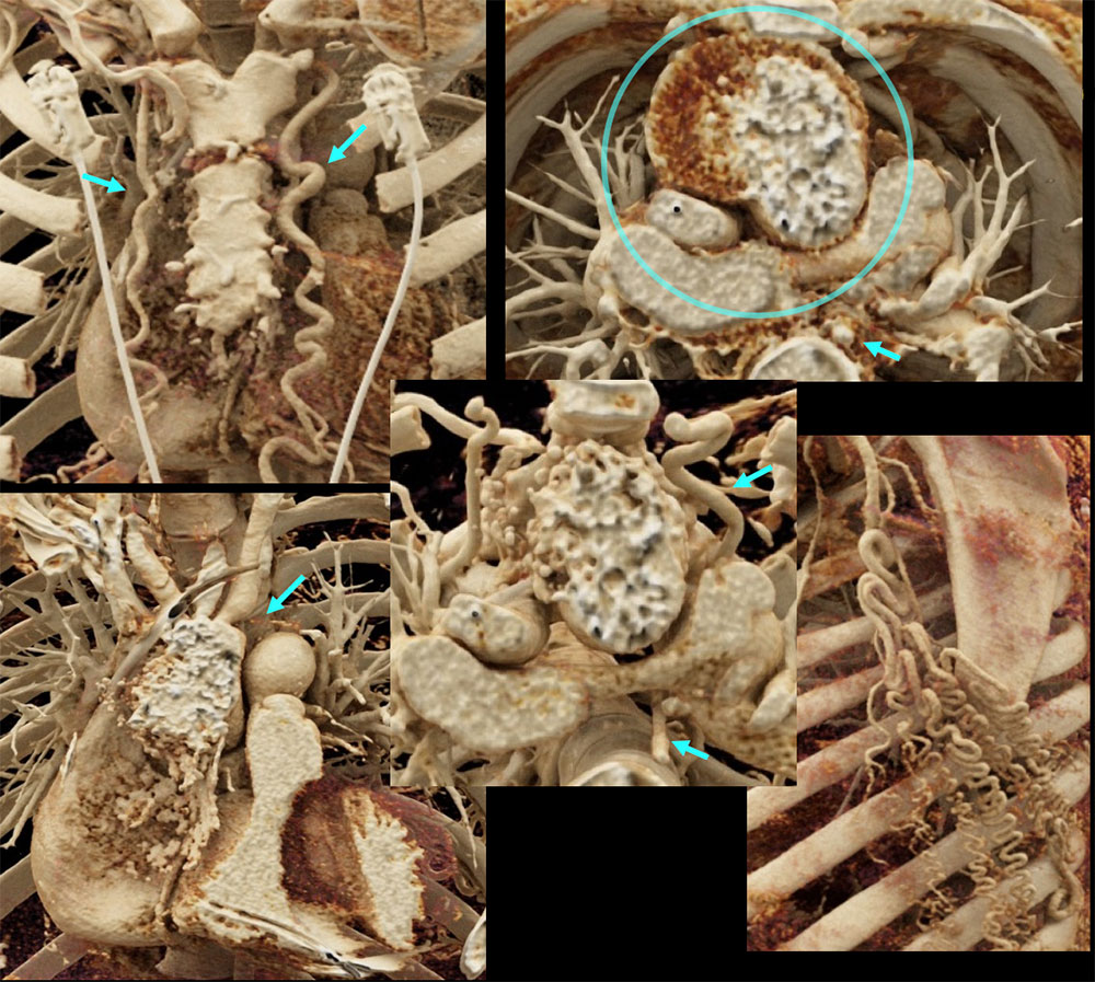 CT of Hypoplastic Arch and Calcification