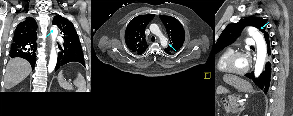 CT of Traumatic Aortic Injury (TAI)