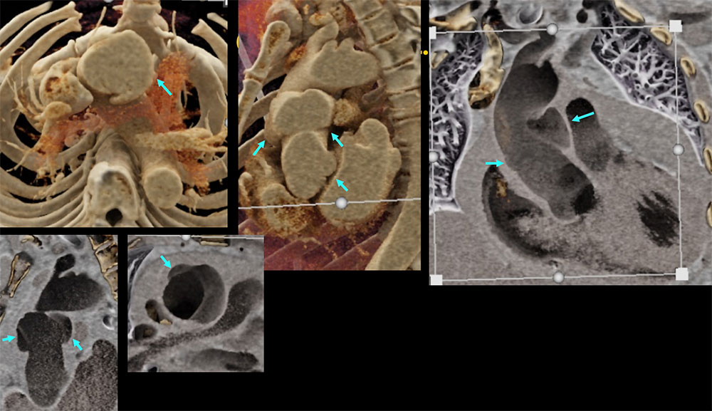 CT of Type A Dissection & Pseudoaneurysms