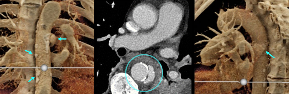 CT of Penetrating Ulcers/Mycotic Aneurysms