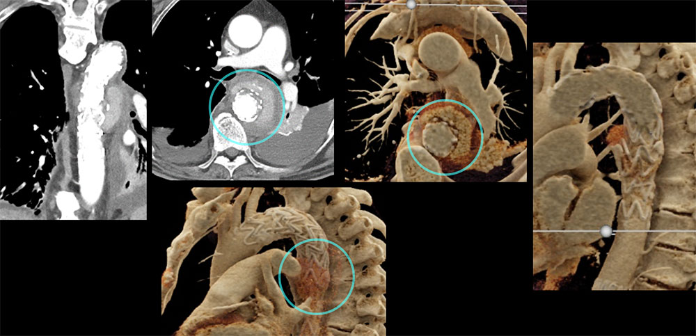 CT of Penetrating Ulcers/Mycotic Aneurysms