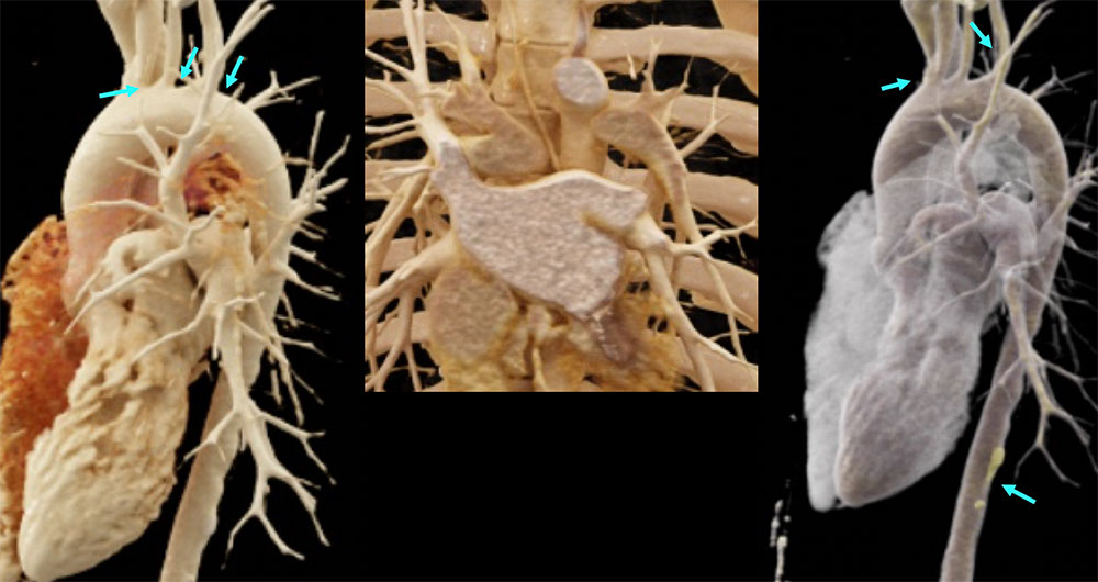 CT of Takayasu Arteritis