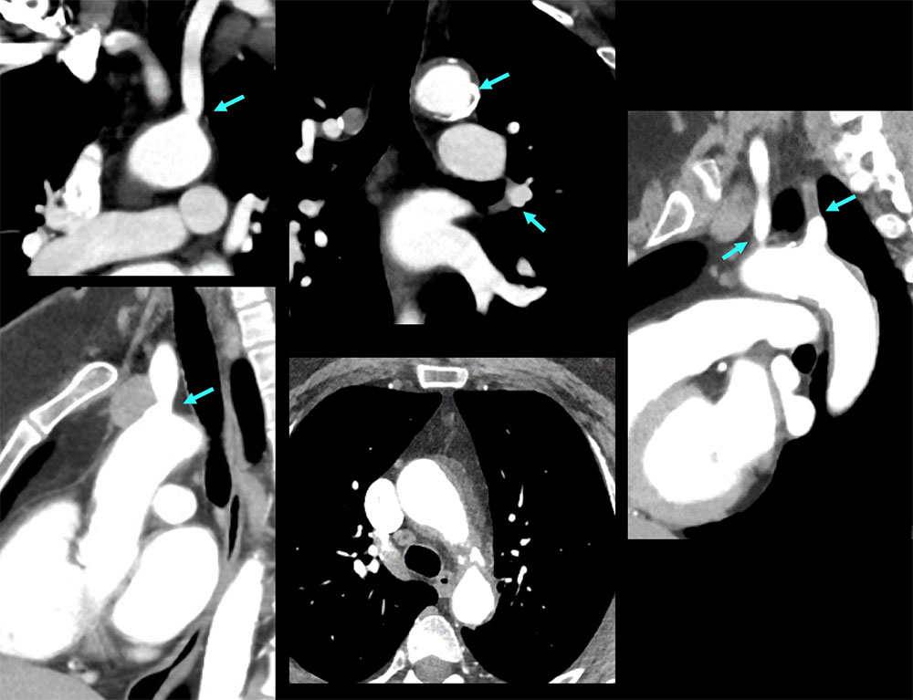 CT of Takayasu Arteritis