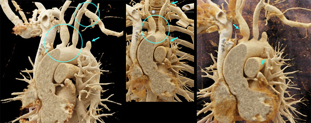 CT of Takayasu Arteritis