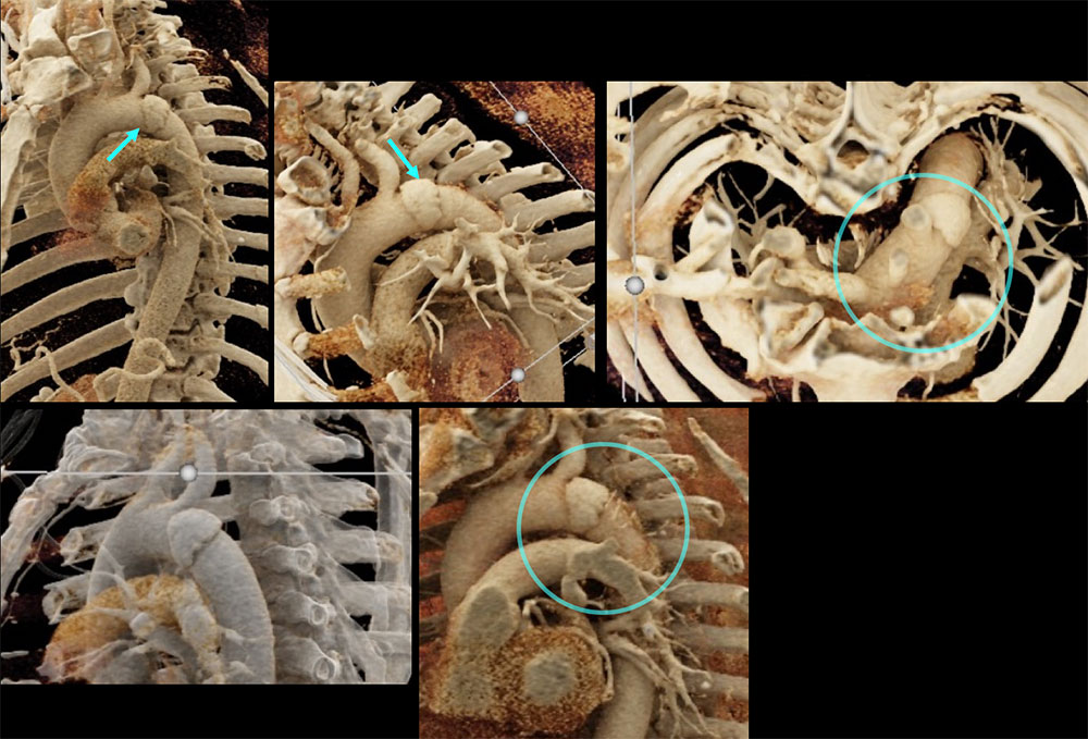 CT of Traumatic Aortic Injury (TAI)