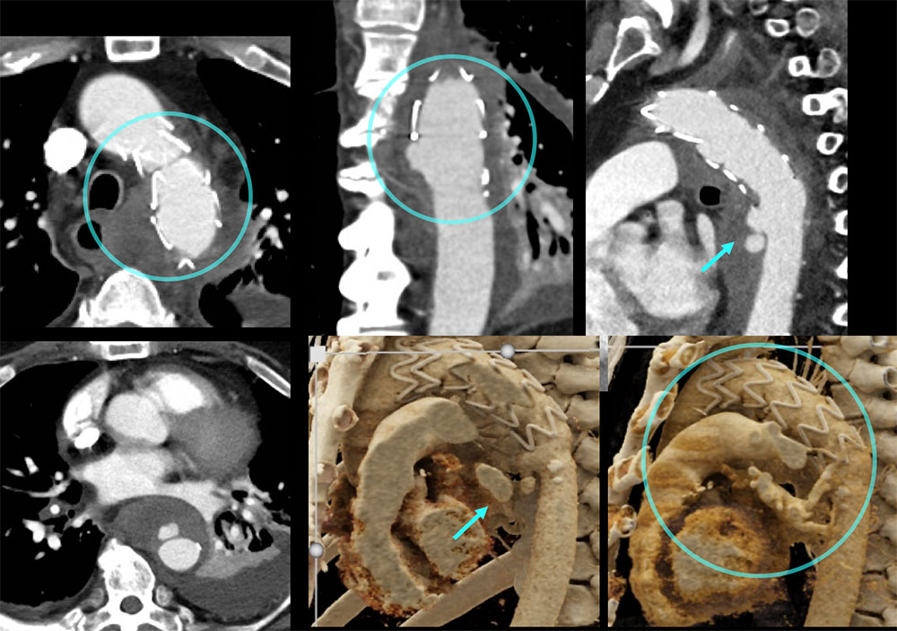 CT of Impending Mycotic Aneurysm Rupture