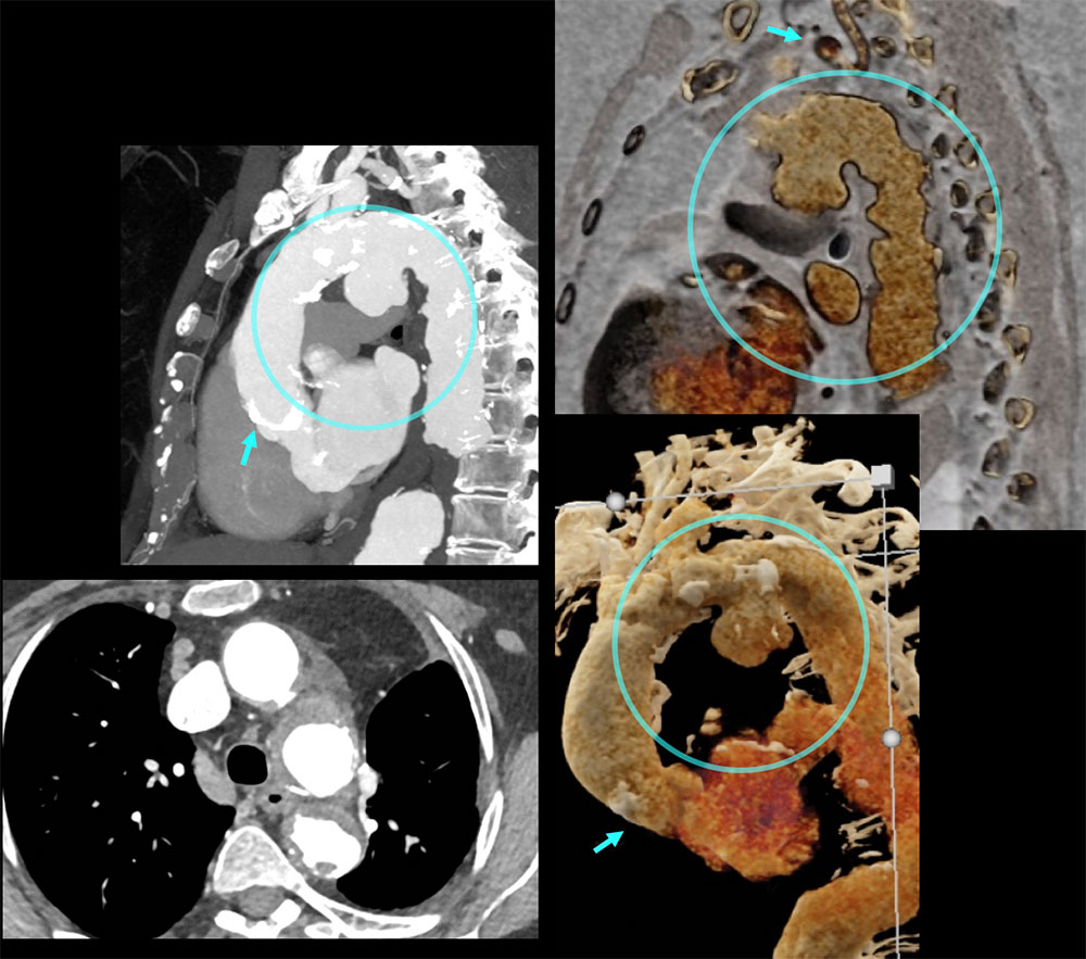 CT of Saccular Aneurysm Operative Planning