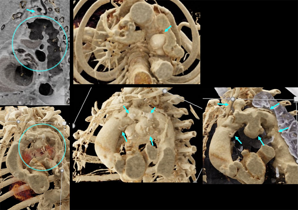 CT of Saccular Aneurysm Operative Planning