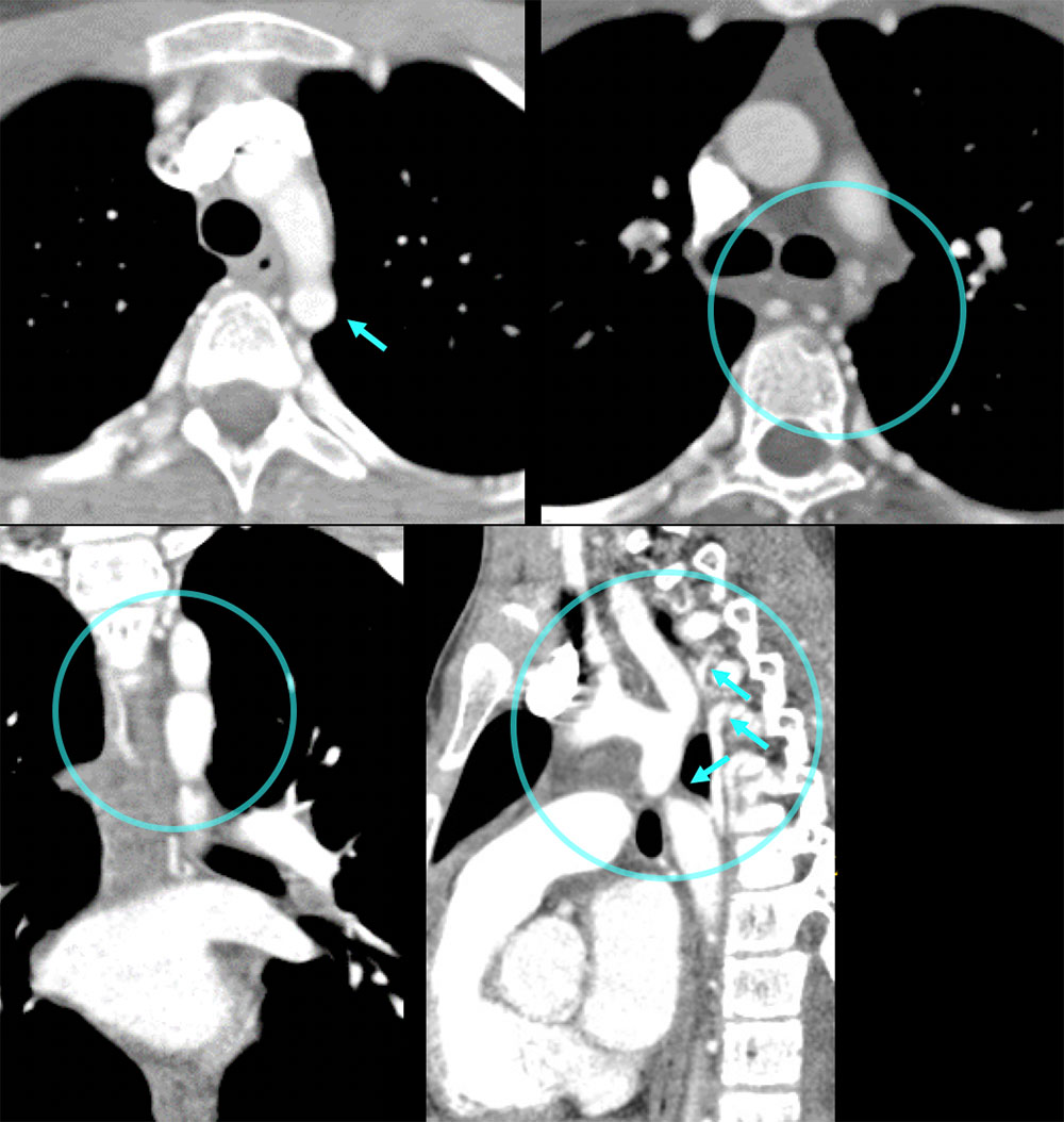 CT of Coarctation (Initial)