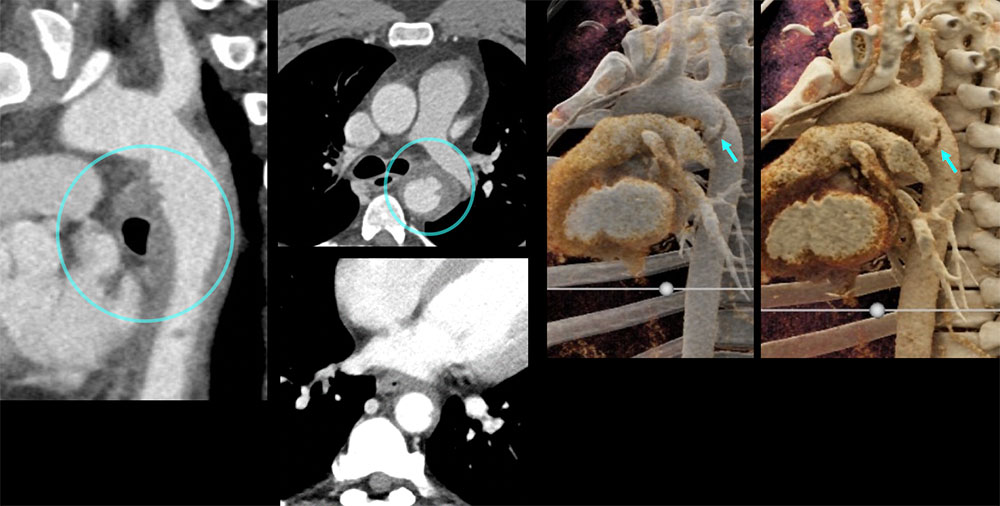 CT of TAI, Intramural Hematoma (IMH)