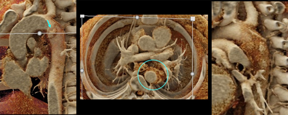 CT of TAI, Intramural Hematoma (IMH)