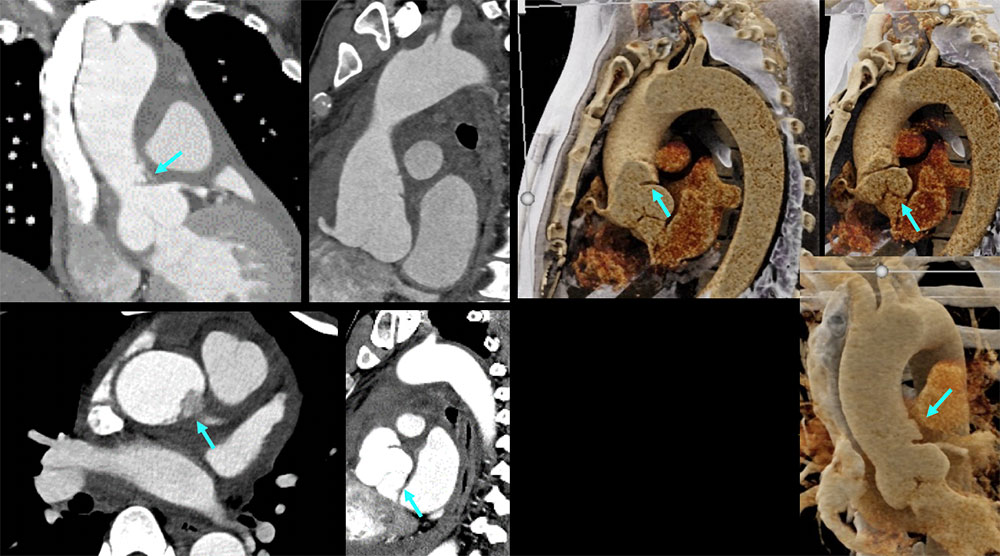 CT of Ruptured Focal Dissection