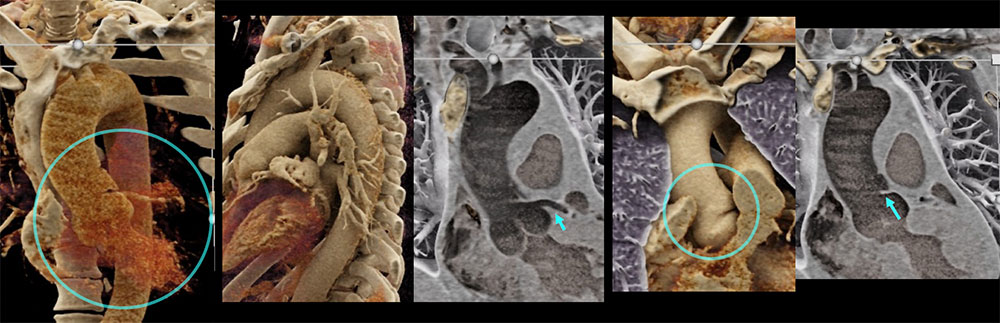 CT of Ruptured Focal Dissection