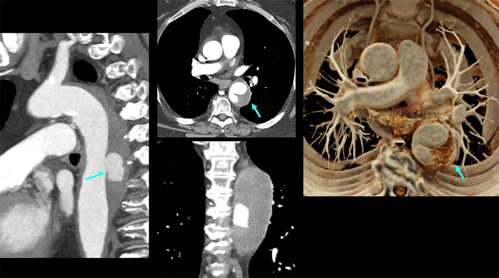 CT of Type B Intramural Hematoma