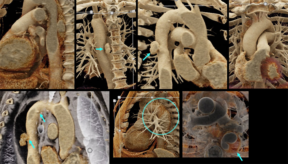 CT of Type B Intramural Hematoma