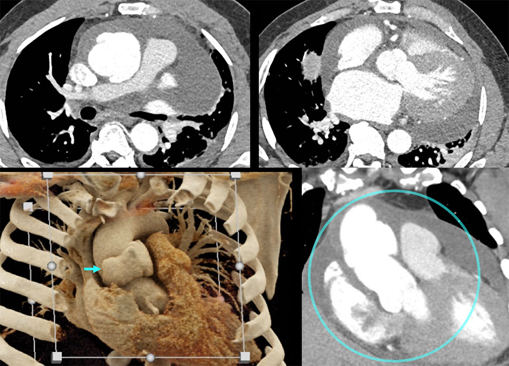 CT of Type A Dissection & Pseudoaneurysms