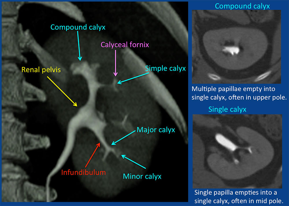 Normal Anatomy of Renal Collecting System